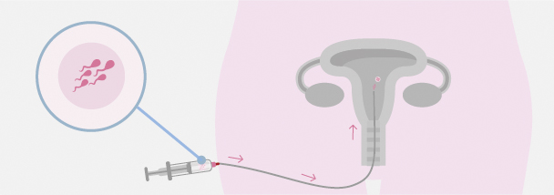 inseminacion artificial