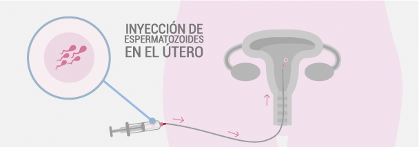inyección de espermatozoides en el utero