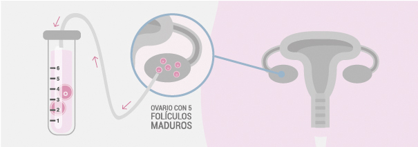 puncion folicular