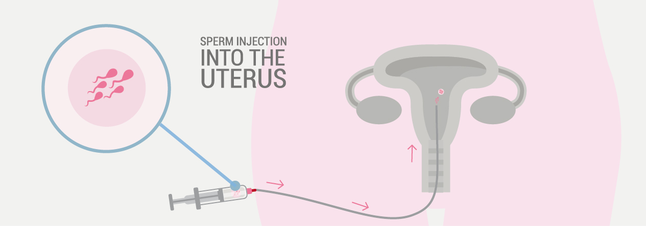 sperm injection into uterus 