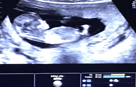 «A principios de enero escuchamos por 1ª vez el corazón de nuestro bebé»